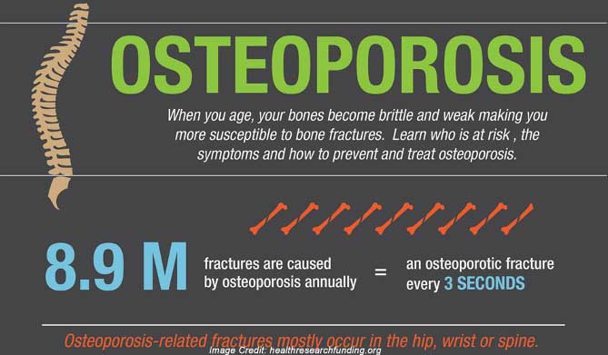 osteoporosis-info